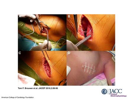 Tom F. Brouwer et al. JACEP 2016;2:89-96