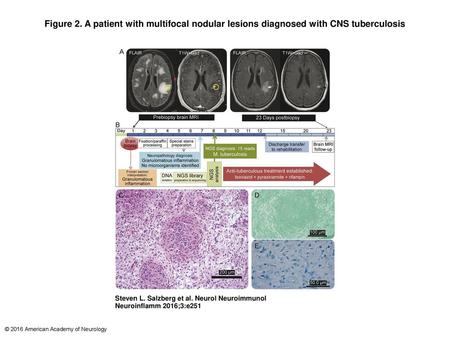 Figure 2. A patient with multifocal nodular lesions diagnosed with CNS tuberculosis A patient with multifocal nodular lesions diagnosed with CNS tuberculosis.