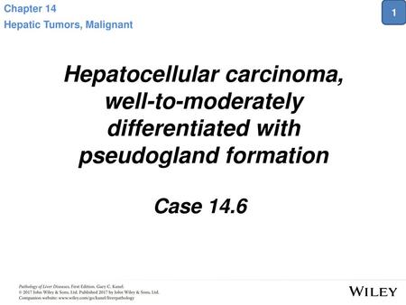 Chapter 14 Hepatic Tumors, Malignant 1