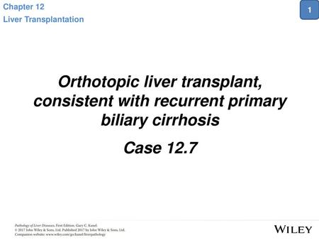 Chapter 12 Liver Transplantation 1