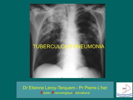 TUBERCULOUS PNEUMONIA