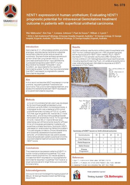 HENT1 expression in human urothelium; Evaluating hENT1 prognostic potential for intravesical Gemcitabine treatment outcome in patients with superficial.