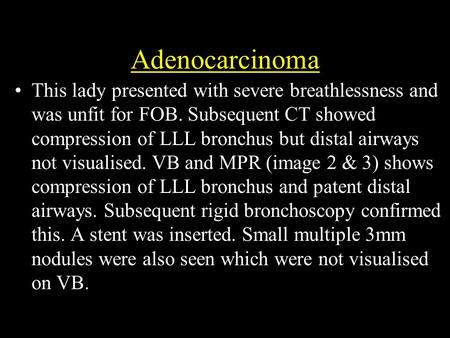 Adenocarcinoma This lady presented with severe breathlessness and was unfit for FOB. Subsequent CT showed compression of LLL bronchus but distal airways.