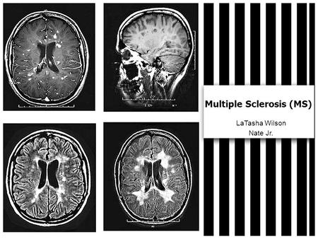 Multiple Sclerosis (MS) LaTasha Wilson Nate Jr.. Pathophysiology of MS In MS, the body’s own defense system attacks myelin, the fatty substance that surrounds.