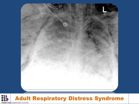 Adult Respiratory Distress Syndrome