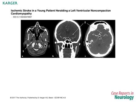 Ischemic Stroke in a Young Patient Heralding a Left Ventricular Noncompaction Cardiomyopathy - DOI:10.1159/000479957 Fig. 1. a–c CT scan obtained on admission.