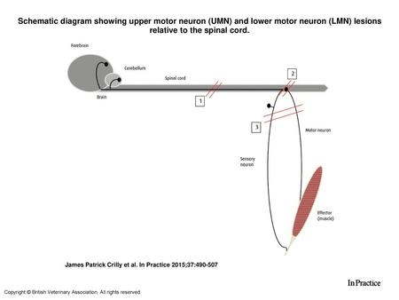 Schematic diagram showing upper motor neuron (UMN) and lower motor neuron (LMN) lesions relative to the spinal cord. Schematic diagram showing upper motor.