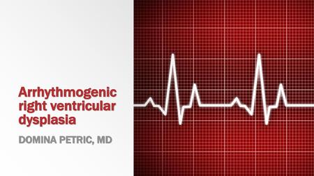 Arrhythmogenic right ventricular dysplasia