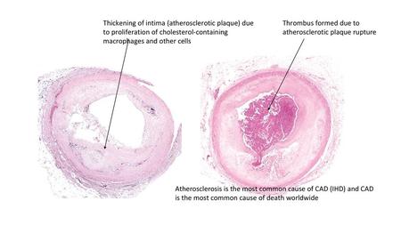 Thickening of intima (atherosclerotic plaque) due to proliferation of cholesterol-containing macrophages and other cells Thrombus formed due to atherosclerotic.