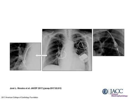 José L. Morales et al. JACEP 2017;j.jacep