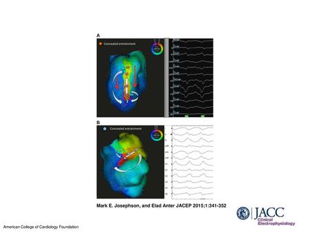 Mark E. Josephson, and Elad Anter JACEP 2015;1: