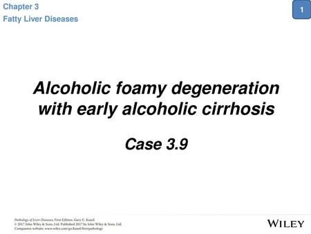 Alcoholic foamy degeneration with early alcoholic cirrhosis