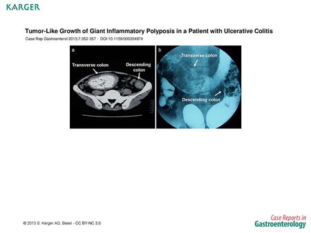 Case Rep Gastroenterol 2013;7: DOI: /