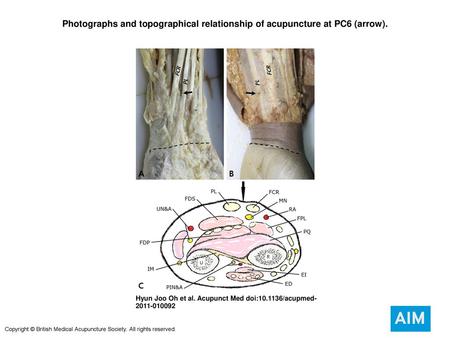 Photographs and topographical relationship of acupuncture at PC6 (arrow). Photographs and topographical relationship of acupuncture at PC6 (arrow). PC6.