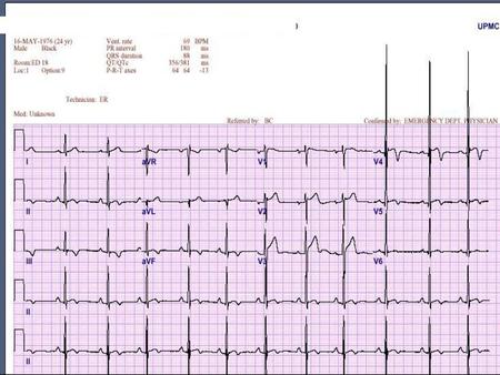 LVH & Heart murmur Murmur Increased w/ standing