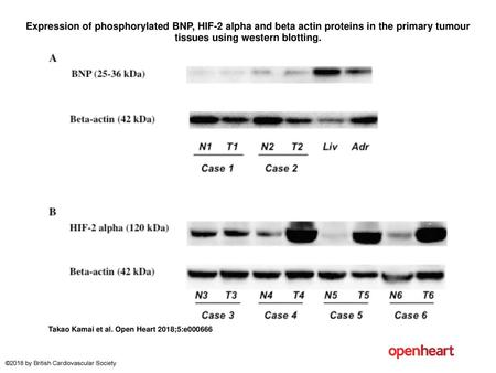 Expression of phosphorylated BNP, HIF-2 alpha and beta actin proteins in the primary tumour tissues using western blotting. Expression of phosphorylated.