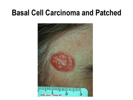 Basal Cell Carcinoma and Patched