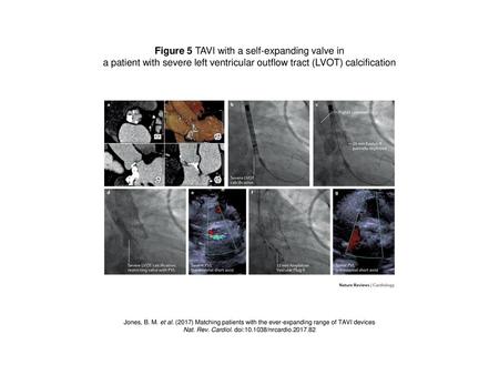 Figure 5 TAVI with a self-expanding valve in