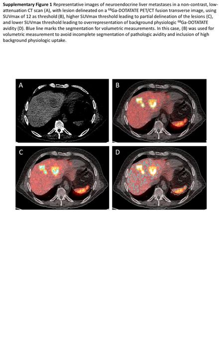 Supplementary Figure 1 Representative images of neuroendocrine liver metastases in a non-contrast, low-attenuation CT scan (A), with lesion delineated.