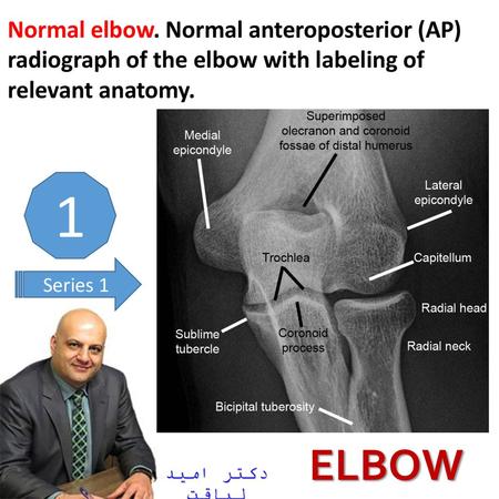 Normal elbow. Normal anteroposterior (AP) radiograph of the elbow with labeling of relevant anatomy. 1 Series 1 ELBOW دکتر امید لیاقت.