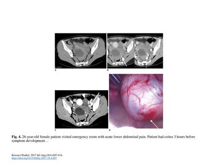 Fig. 4. 26-year-old female patient visited emergency room with acute lower abdominal pain. Patient had coitus 3 hours before symptom development. A. Precontrast.