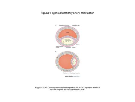 Figure 1 Types of coronary artery calcification