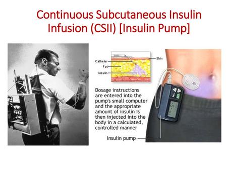 Continuous Subcutaneous Insulin Infusion (CSII) [Insulin Pump]