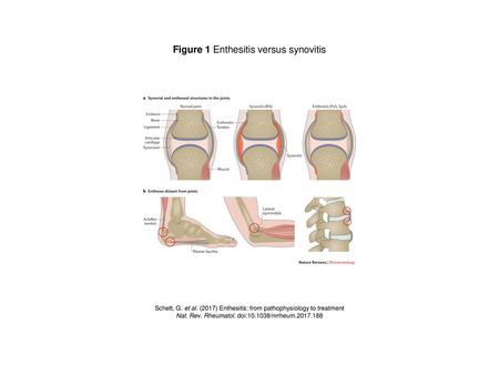 Figure 1 Enthesitis versus synovitis