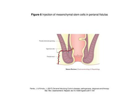 Figure 6 Injection of mesenchymal stem cells in perianal fistulas