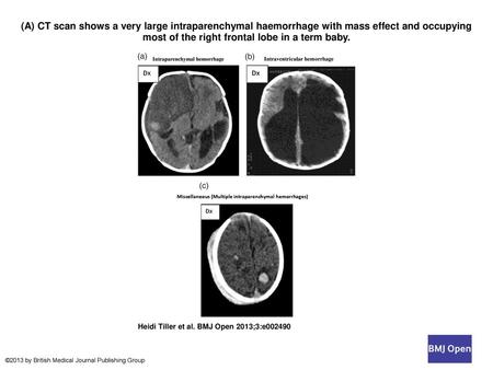 (A) CT scan shows a very large intraparenchymal haemorrhage with mass effect and occupying most of the right frontal lobe in a term baby. (A) CT scan shows.