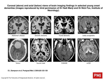 Coronal (above) and axial (below) views of brain imaging findings in selected young onset dementias (images reproduced by kind permission of Dr Hadi Manji.