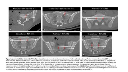 Axial view – Left Iliosacral at S1