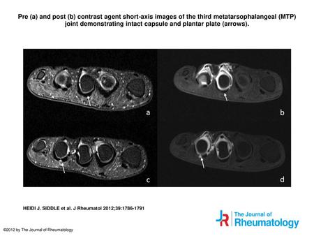 Pre (a) and post (b) contrast agent short-axis images of the third metatarsophalangeal (MTP) joint demonstrating intact capsule and plantar plate (arrows).