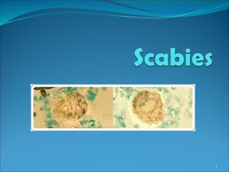 Scabies.