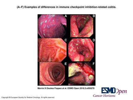 (A–F) Examples of differences in immune checkpoint inhibition-related colitis. (A–F) Examples of differences in immune checkpoint inhibition-related colitis.