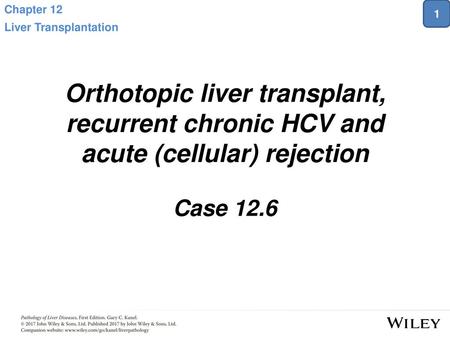 Chapter 12 Liver Transplantation 1