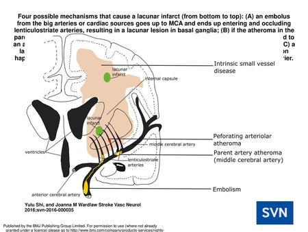 Four possible mechanisms that cause a lacunar infarct (from bottom to top): (A) an embolus from the big arteries or cardiac sources goes up to MCA and.