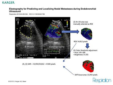 Elastography for Predicting and Localizing Nodal Metastases during Endobronchial Ultrasound Respiration 2015;90:499-506 - DOI:10.1159/000441798 Fig. 1.