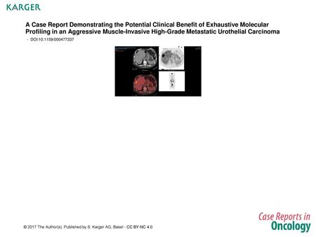 A Case Report Demonstrating the Potential Clinical Benefit of Exhaustive Molecular Profiling in an Aggressive Muscle-Invasive High-Grade Metastatic Urothelial.