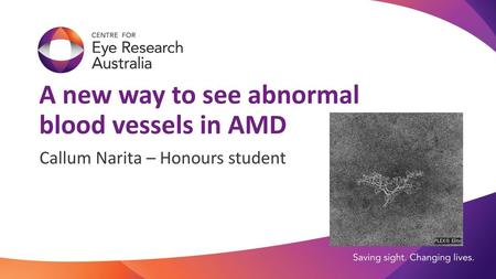 A new way to see abnormal blood vessels in AMD