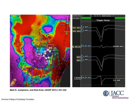 Mark E. Josephson, and Elad Anter JACEP 2015;1: