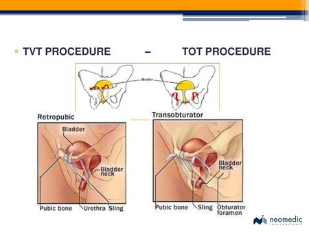 TVT PROCEDURE – TOT PROCEDURE