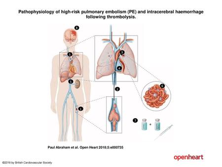 Pathophysiology of high-risk pulmonary embolism (PE) and intracerebral haemorrhage following thrombolysis. Pathophysiology of high-risk pulmonary embolism.