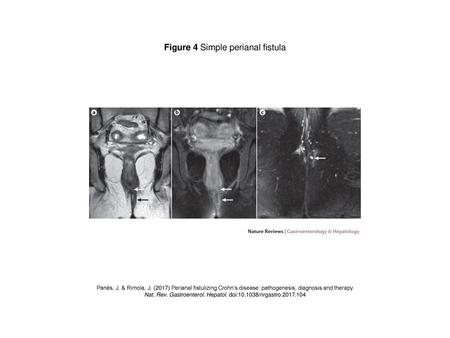 Figure 4 Simple perianal fistula