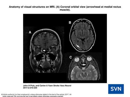 Anatomy of visual structures on MRI