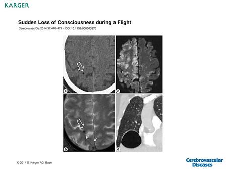 Sudden Loss of Consciousness during a Flight