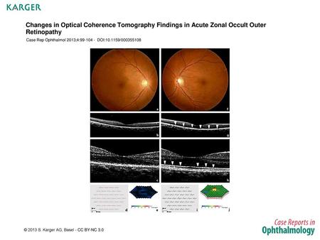 Case Rep Ophthalmol 2013;4: DOI: /