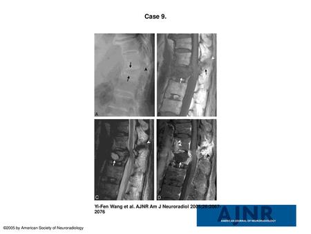 Case 9. Case 9. Imaging studies, 1 month after a fall. This patient had fracture in the L1 vertebral body with avascular necrosis. There was also fracture.