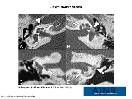 Bilateral cavitary plaques.