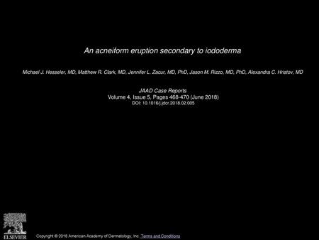 An acneiform eruption secondary to iododerma